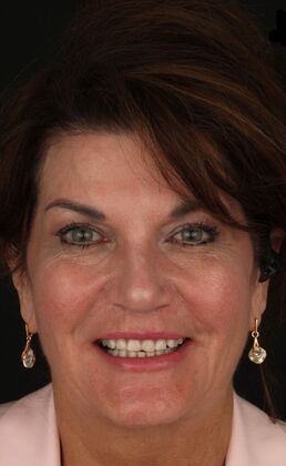 Porcelain Veneers Alina - Before