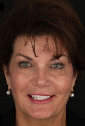 Porcelain Veneers Alina - After