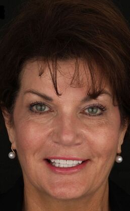 Porcelain Veneers Alina - After