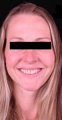 Porcelain Veneers Casey - Before