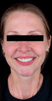 Porcelain Veneers Casey - After