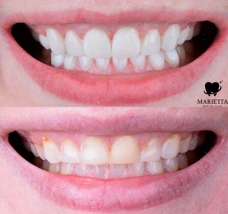 Porcelain Veneers Molli