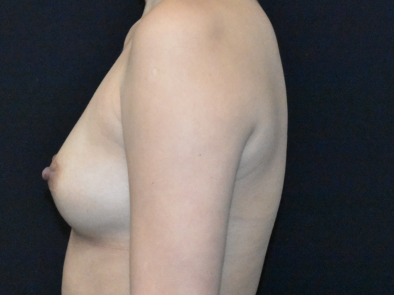 Breast Augmentation: Case 26 - Before