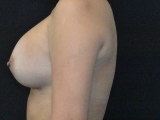 Breast Augmentation: Case 26 - After