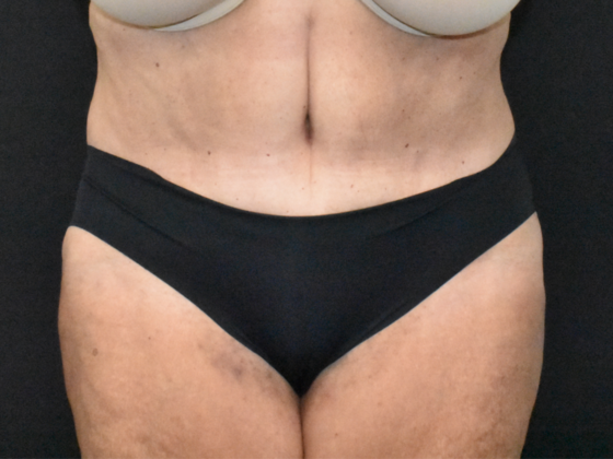 Abdominoplasty Case 33 - After