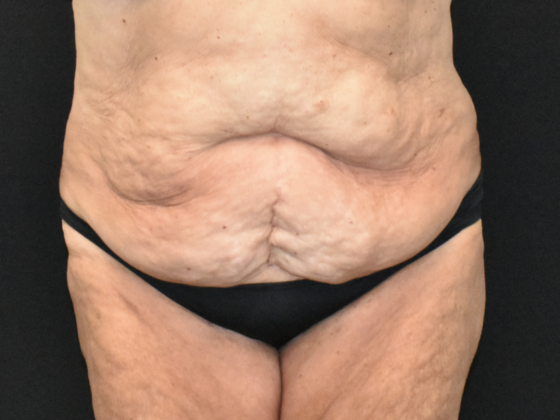 Abdominoplasty Case 33 - Before