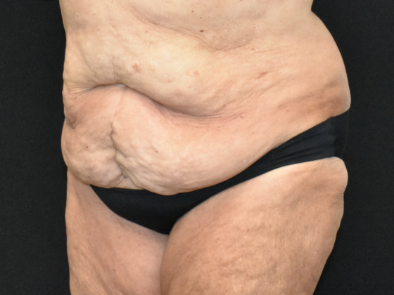 Abdominoplasty: Case 33 - Before