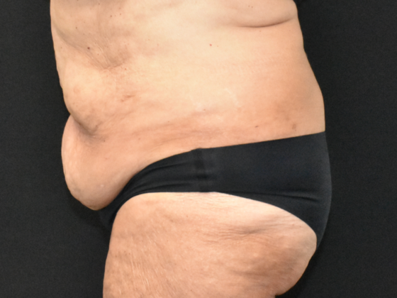 Abdominoplasty: Case 33 - Before