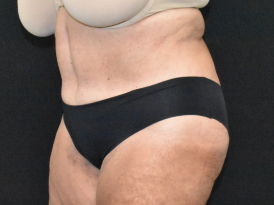 Abdominoplasty: Case 33 - After