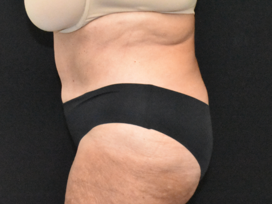 Abdominoplasty: Case 33 - After