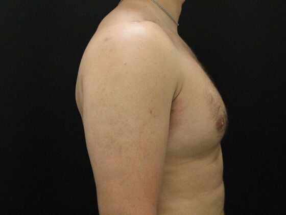 Gynecomastia: Case 10 - Before