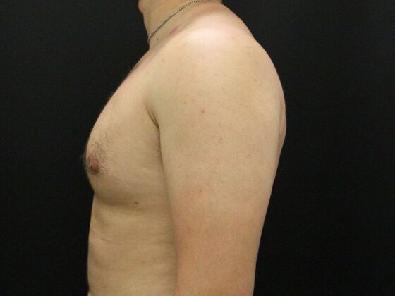 Gynecomastia: Case 10 - Before