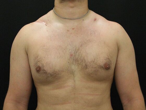 Gynecomastia: Case 10 - Before