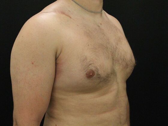 Gynecomastia: Case 10 - Before