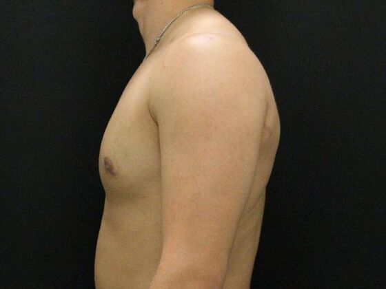 Gynecomastia: Case 10 - After