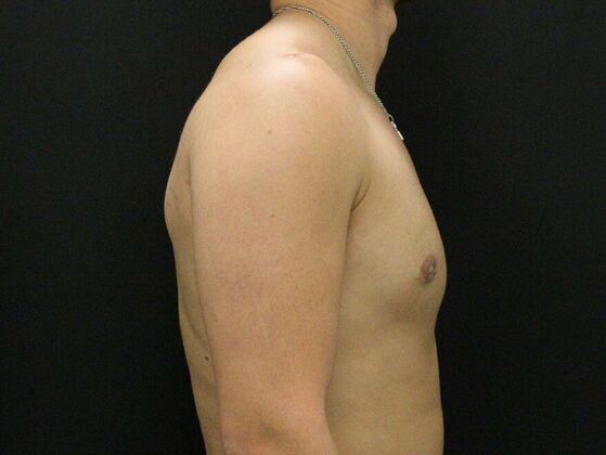 Gynecomastia: Case 10 - After
