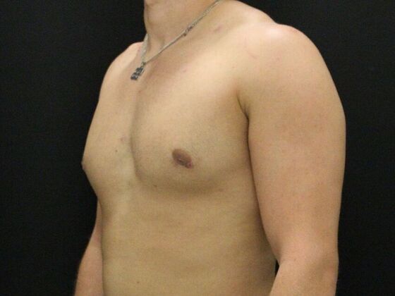 Gynecomastia Case 10 - After