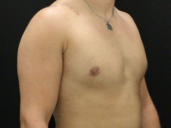Gynecomastia: Case 10 - After