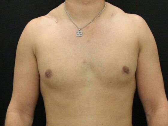 Gynecomastia: Case 10 - After