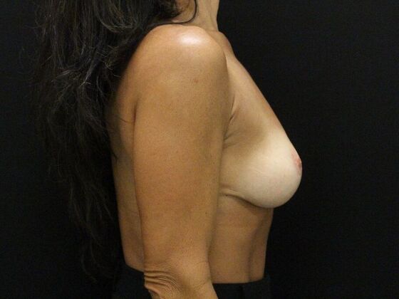 Breast Lift/Breast Lift Augmentation: Case 68 - After