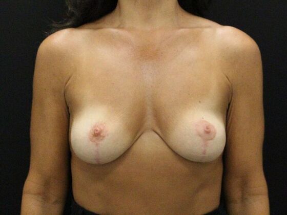 Breast Lift/Breast Lift Augmentation: Case 68 - After