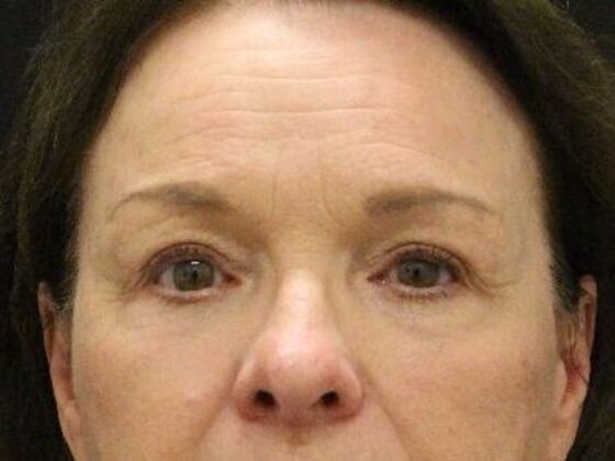 Forehead & Brow Lifts Case 4 - After