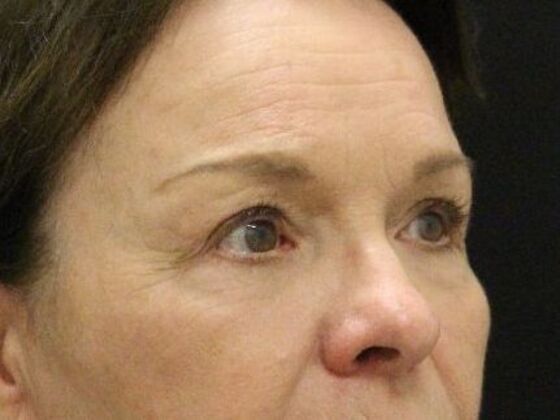 Forehead & Brow Lifts: Case 4 - After