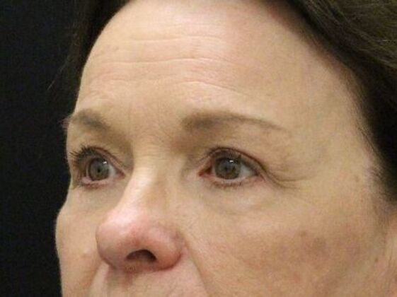 Forehead & Brow Lifts: Case 4 - After