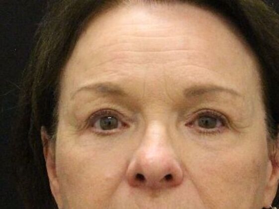 Eyelid Surgery Case 17 - After