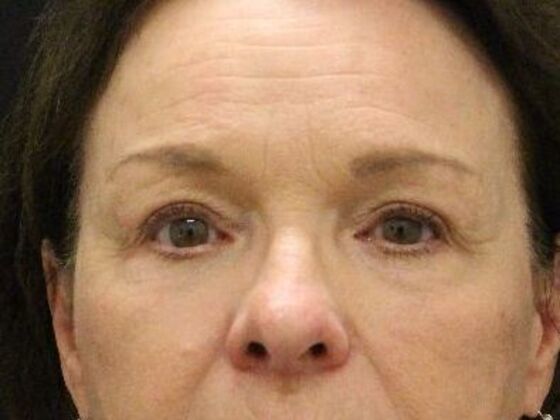 Non-Surgical: Case 12 - After