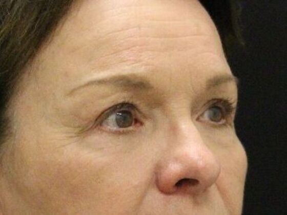 Non-Surgical: Case 12 - After