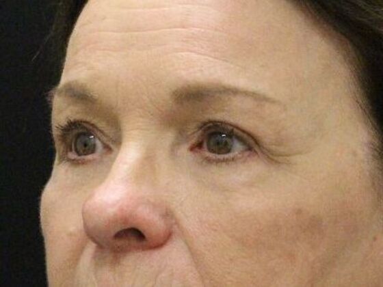 Non-Surgical: Case 12 - After