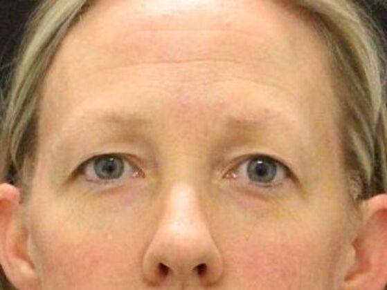 Forehead & Brow Lifts Case 5 - Before