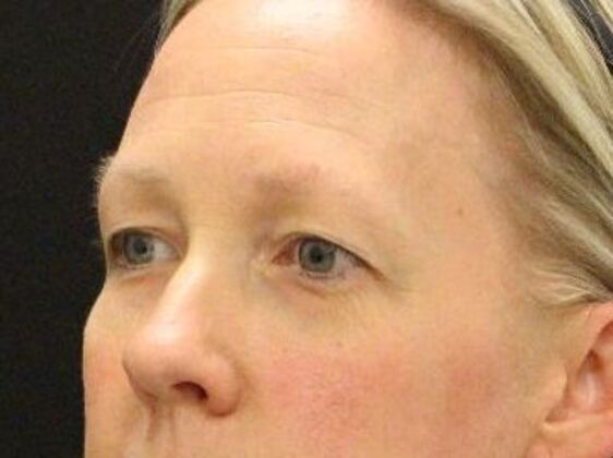 Forehead & Brow Lifts: Case 5 - Before