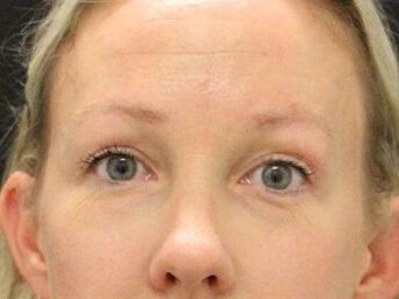 Forehead & Brow Lifts Case 5 - After