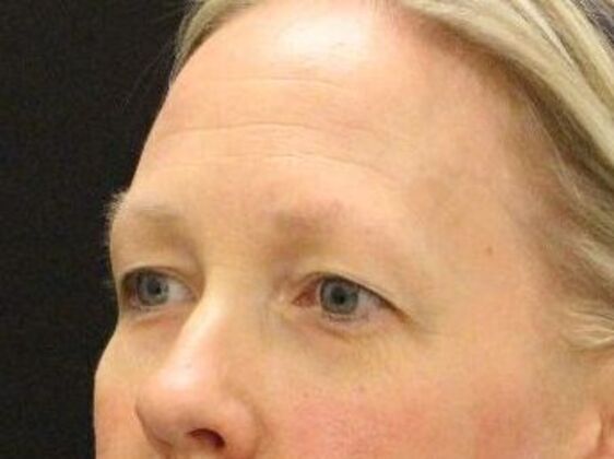 Eyelid Surgery: Case 23 - Before