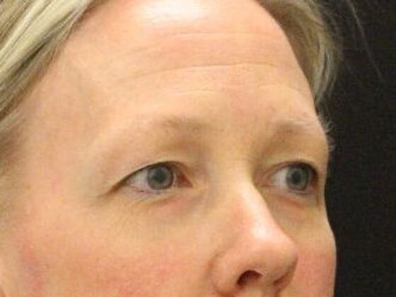 Eyelid Surgery: Case 23 - Before