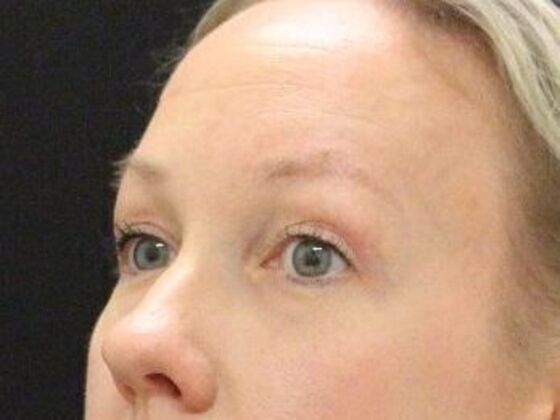 Eyelid Surgery: Case 23 - After