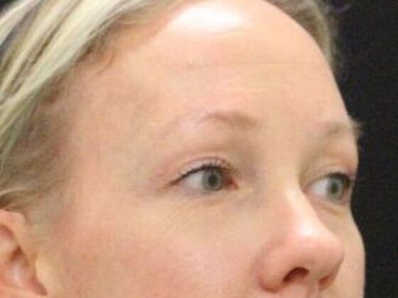 Eyelid Surgery: Case 23 - After