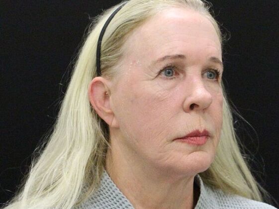 Face & Neck Lifts Case 57 - Before