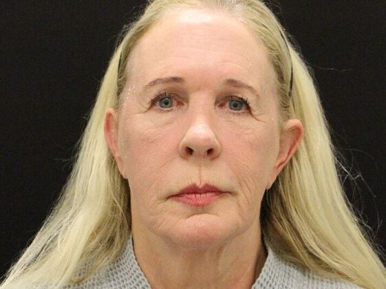 Face & Neck Lifts: Case 57 - Before