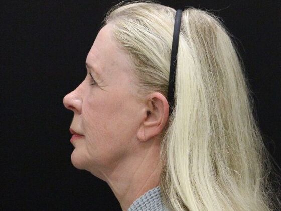 Face & Neck Lifts: Case 57 - Before