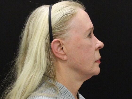 Face & Neck Lifts: Case 57 - Before