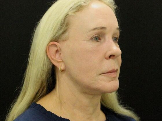 Face & Neck Lifts Case 57 - After