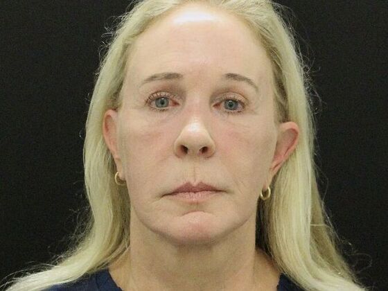 Face & Neck Lifts: Case 57 - After