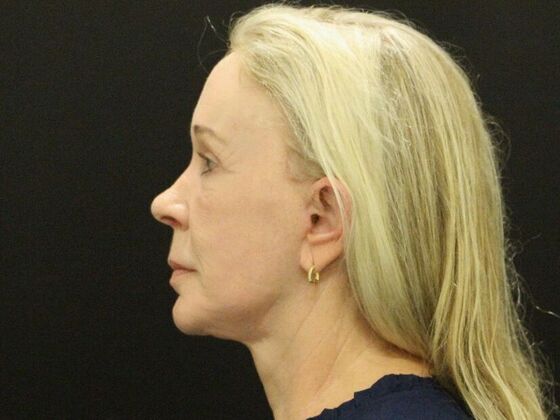 Face & Neck Lifts: Case 57 - After