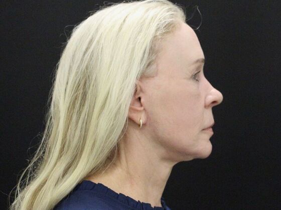 Face & Neck Lifts: Case 57 - After