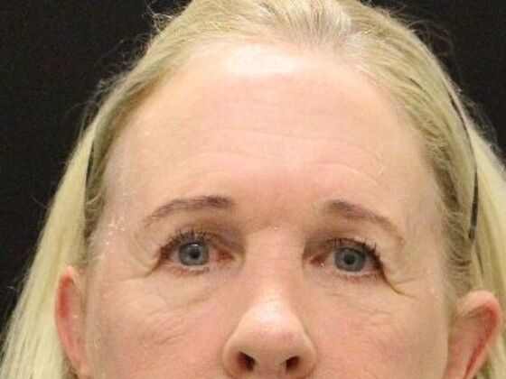 Forehead & Brow Lifts Case 6 - Before