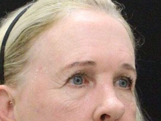 Forehead & Brow Lifts: Case 6 - Before