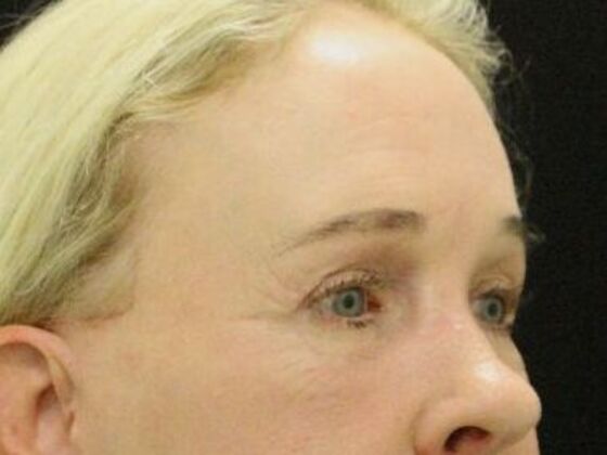 Forehead & Brow Lifts: Case 6 - After